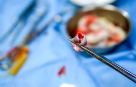  Prélèvement de sang au cordon pour bilan infectieux, faisable et fiable