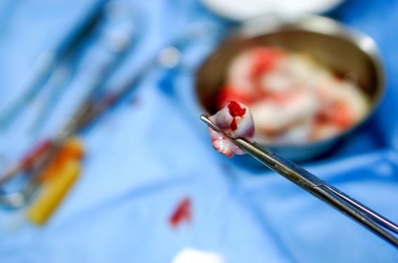  Prélèvement de sang au cordon pour bilan infectieux, faisable et fiable