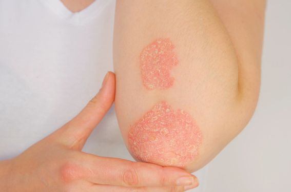 Rhumatisme psoriasique, un mauvais impact des traitements sur le pronostic obstétrical Rhumatisme psoriasique, un mauvais impact des traitements sur le pronostic obstétrical