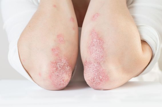 Quelle gestion en pratique du traitement du psoriasis pendant la grossesse ?